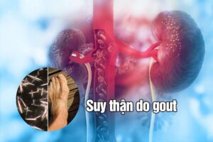gout kèm bệnh thận