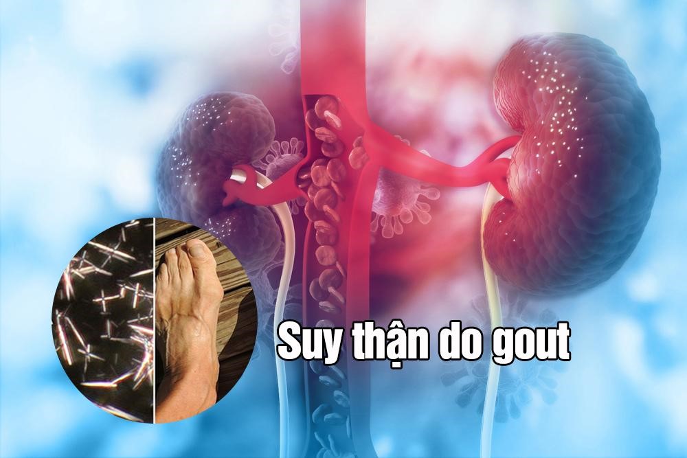 gout kèm bệnh thận