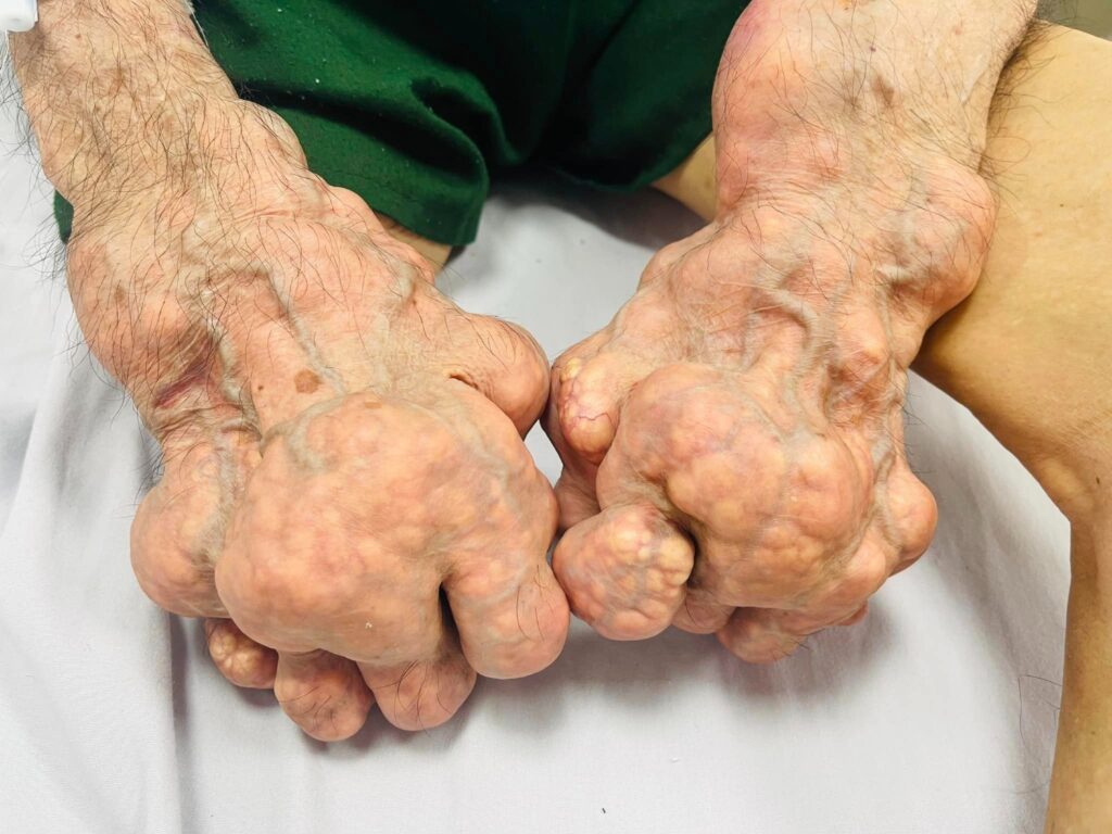 gout kèm tăng huyết áp
