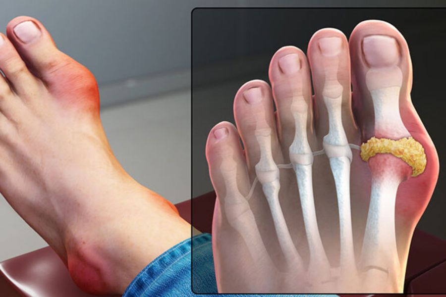 gout kèm tiểu đường - Image 4