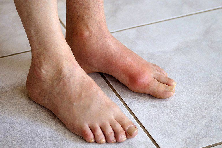 gout mạn tính - Image 2