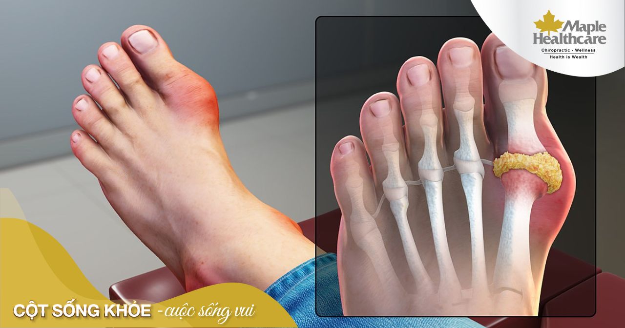 gout mạn tính - Image 3
