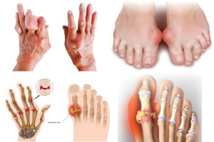 gout mạn tính