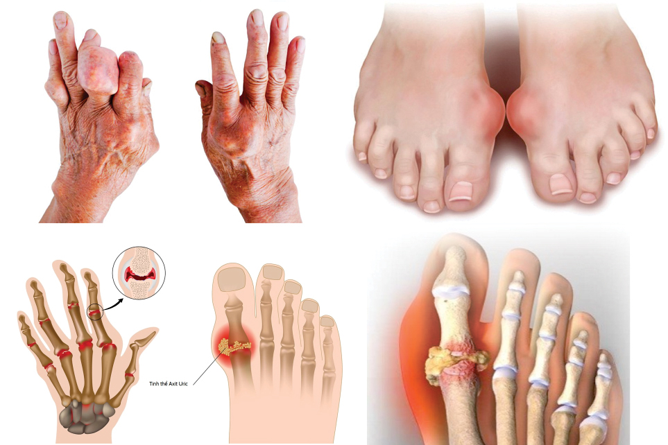 gout mạn tính
