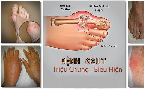 gout ở người cao tuổi - Image 5