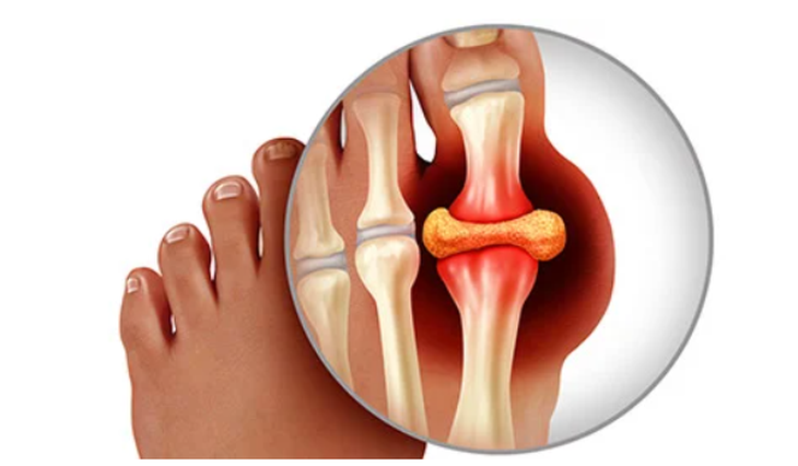gout tái phát nhiều lần - Image 2