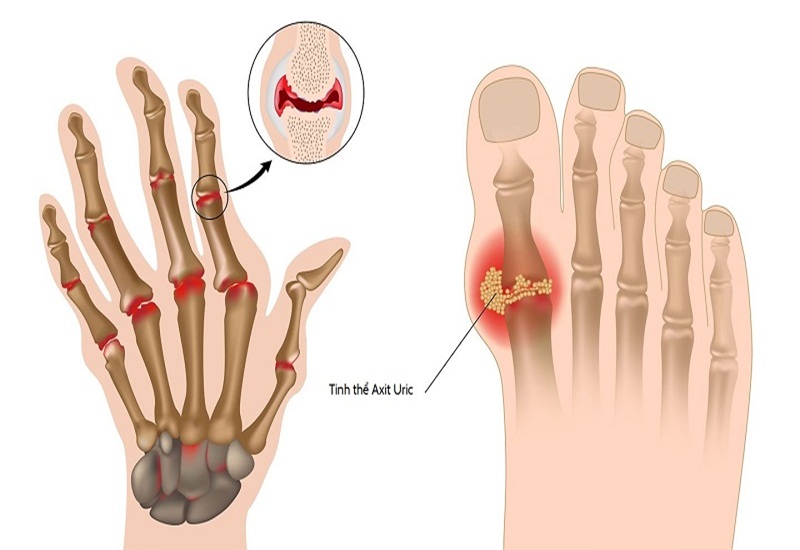 gout và acid uric cao - Image 1