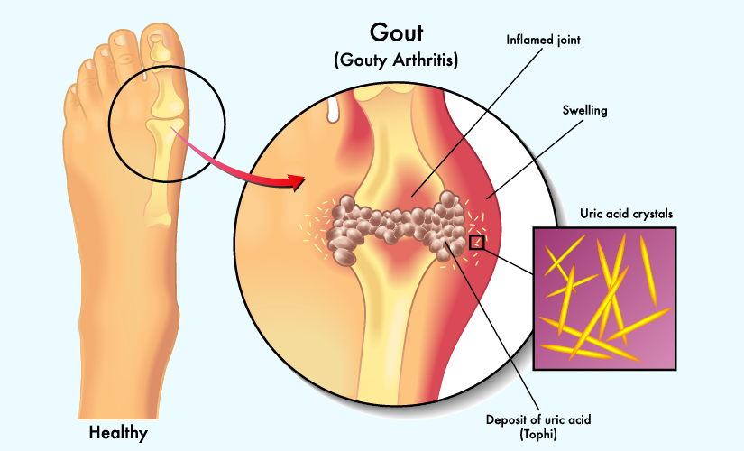 gout và acid uric cao - Image 2