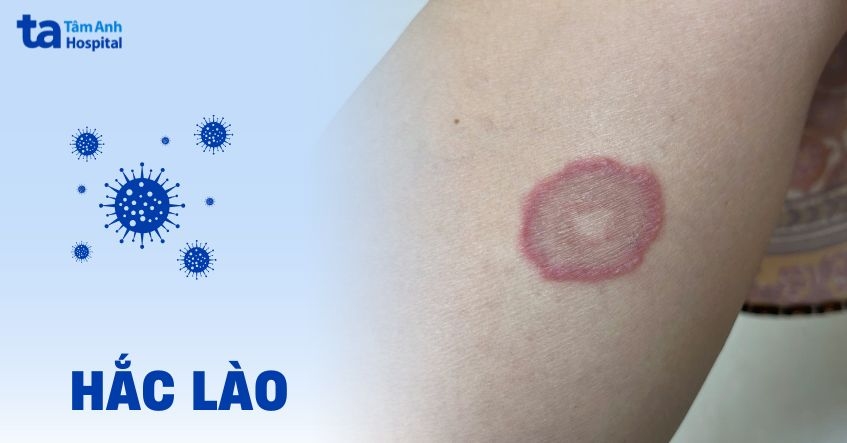 hắc lào ở người bị tiểu đường - Image 4