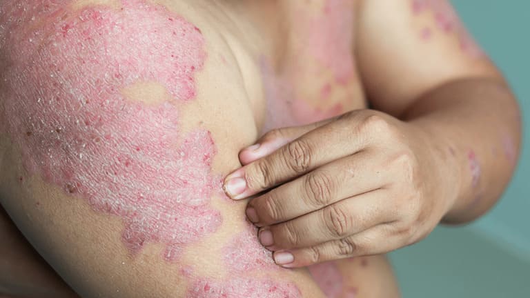 hắc lào ở người lớn - Image 2