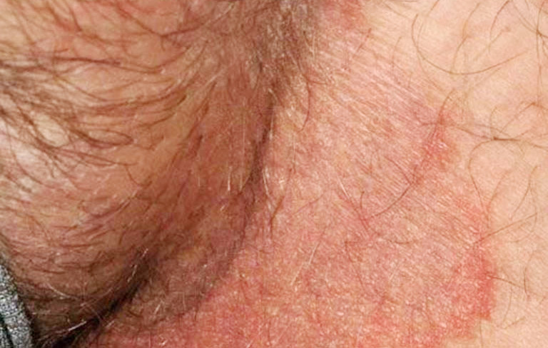 hắc lào ở người lớn - Image 3