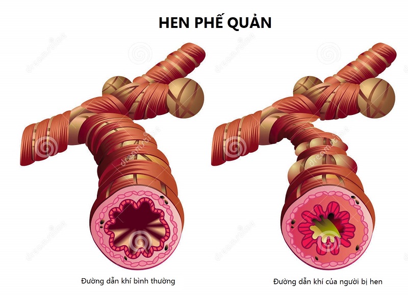 hen phế quản - Image 2