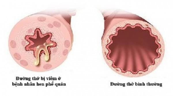 hen phế quản do dị ứng