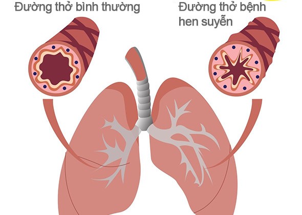 hen phế quản do thời tiết - Image 2
