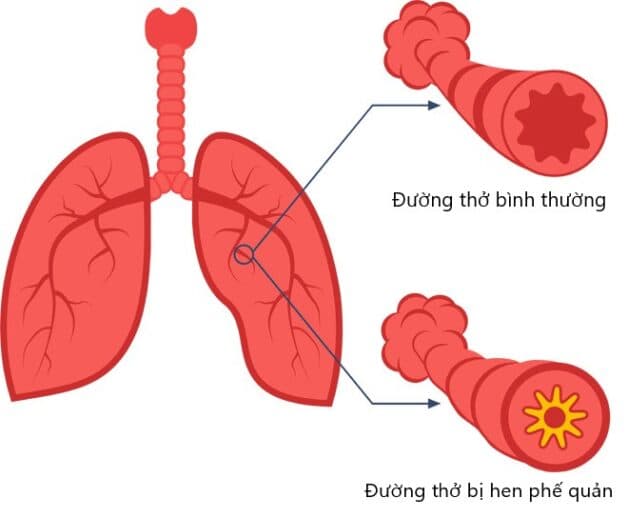 hen phế quản khởi phát ở người lớn - Image 4