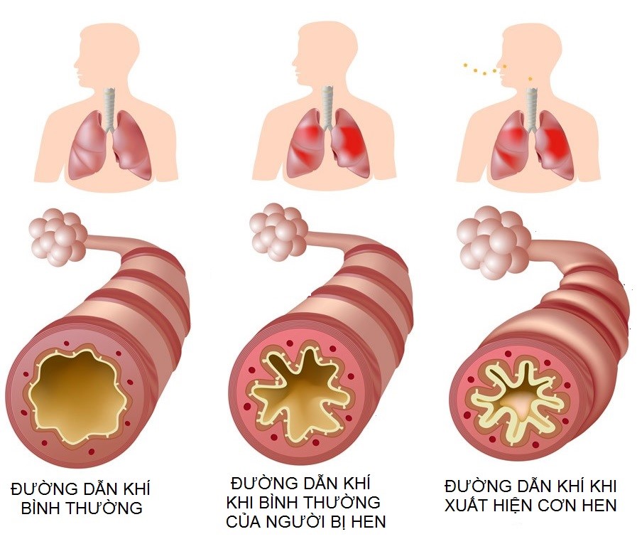 hen phế quản là gì