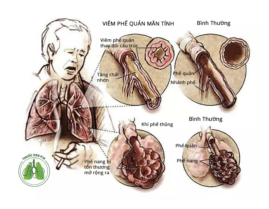 hen phế quản ở người cao tuổi - Image 3