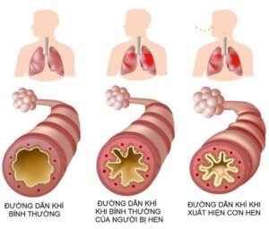 hen phế quản ở người lớn