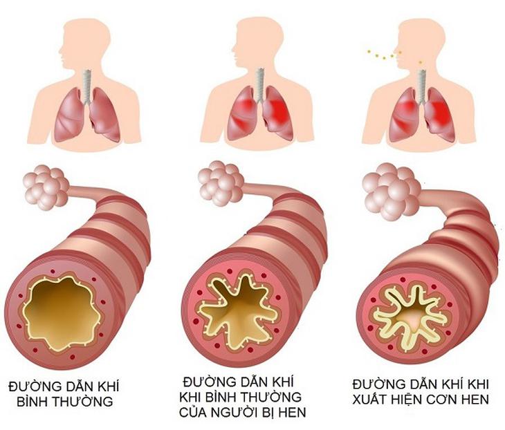 hen phế quản ở người lớn