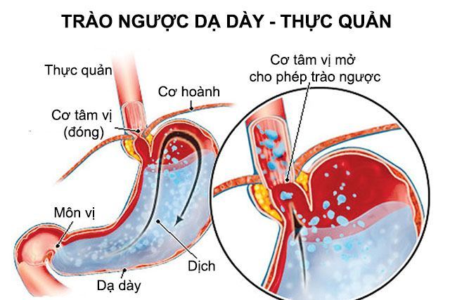 hen phế quản và trào ngược dạ dày - Image 2