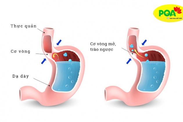 hen phế quản và trào ngược dạ dày - Image 3