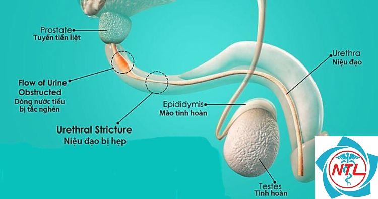 hẹp đường tiết niệu