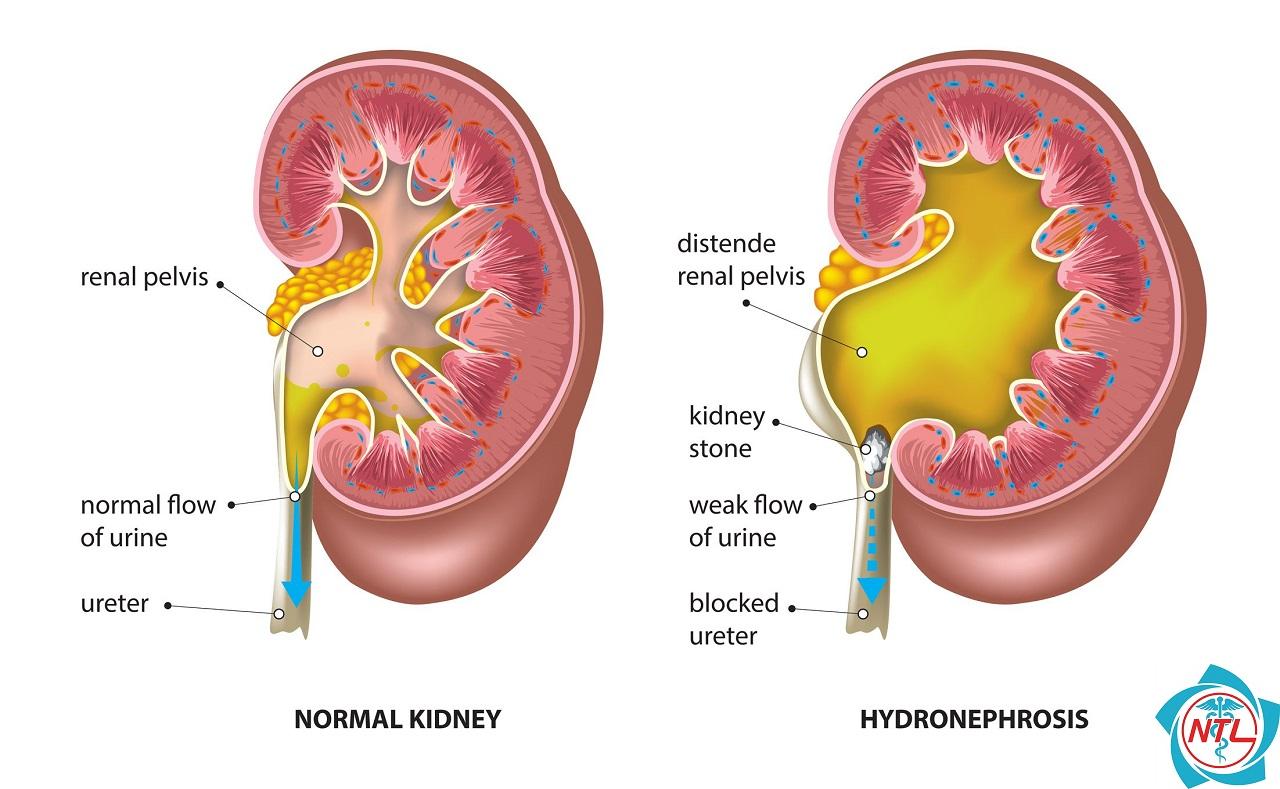 hẹp khúc nối bể thận niệu quản - Image 3