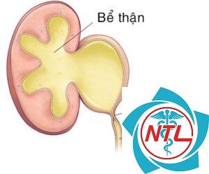 hẹp khúc nối bể thận niệu quản