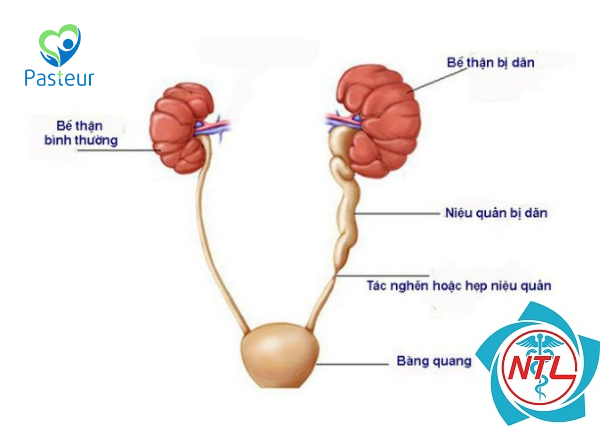 hẹp khúc nối bể thận niệu quản - Image 4