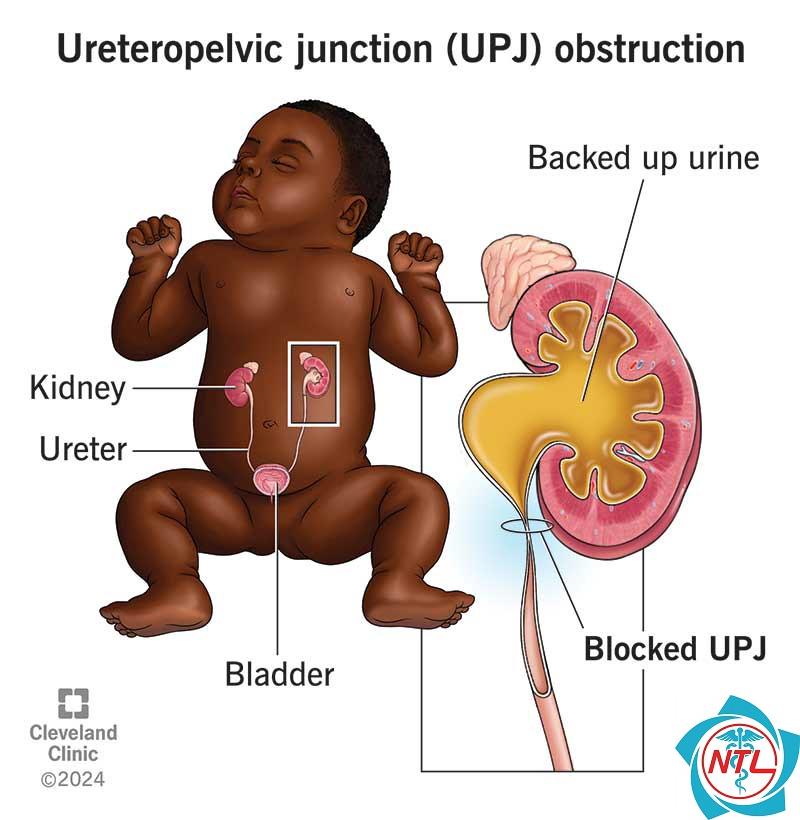 hẹp khúc nối bể thận niệu quản - Image 5
