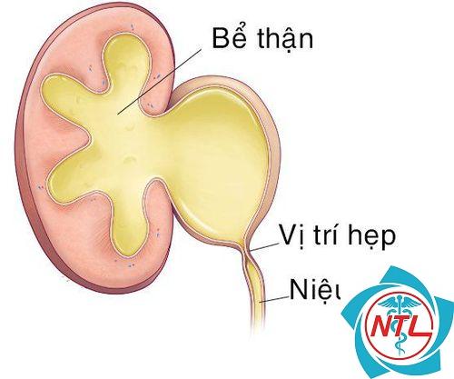 hẹp khúc nối bể thận niệu quản
