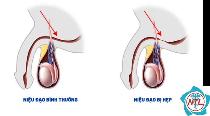 hẹp niệu đạo - Image 3