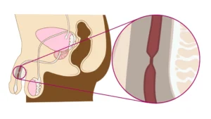 hẹp niệu đạo