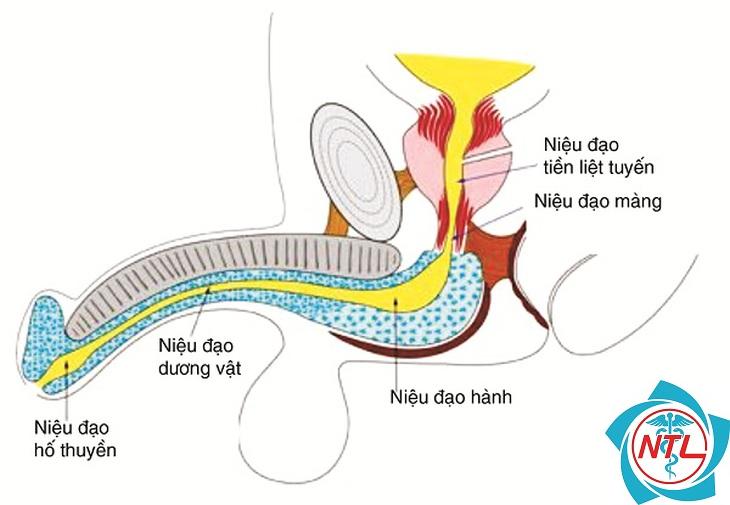 hẹp niệu đạo - Image 5