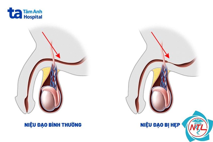 hẹp niệu đạo bẩm sinh - Image 2