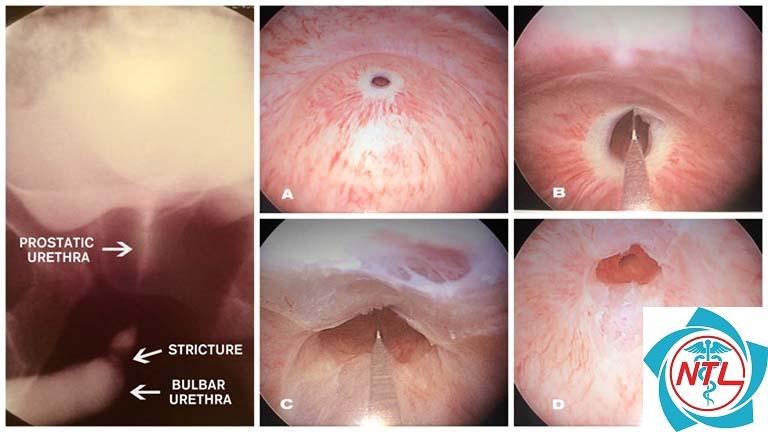 hẹp niệu đạo bẩm sinh - Image 3