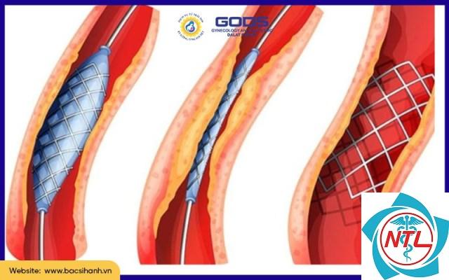 hẹp niệu đạo bẩm sinh - Image 4