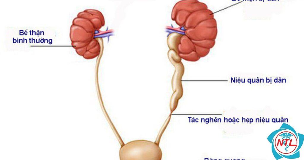 hẹp niệu quản