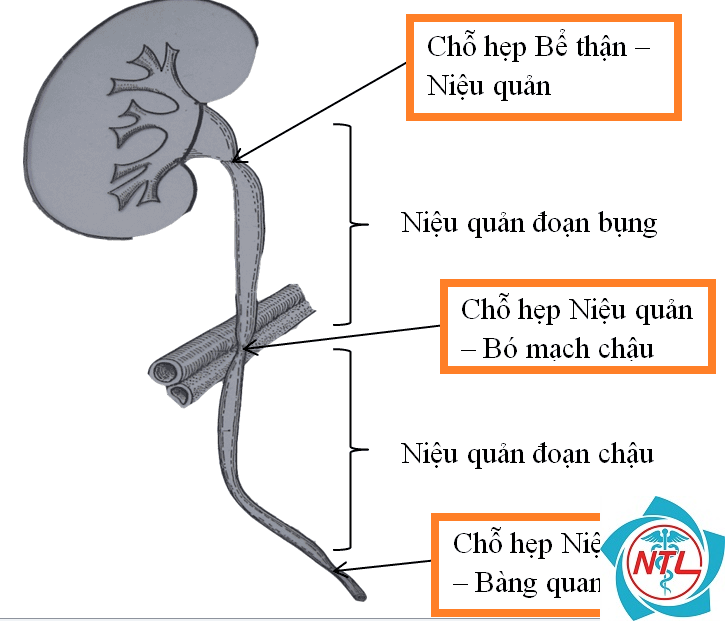 hẹp niệu quản - Image 2