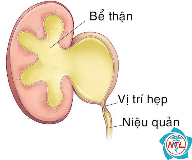 hẹp niệu quản - Image 3