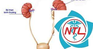 hẹp niệu quản