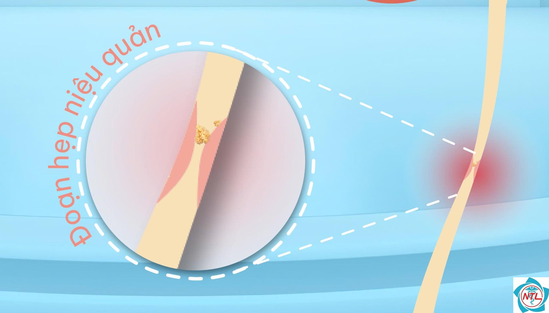 hẹp niệu quản - Image 4