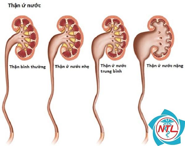 hẹp niệu quản - Image 5
