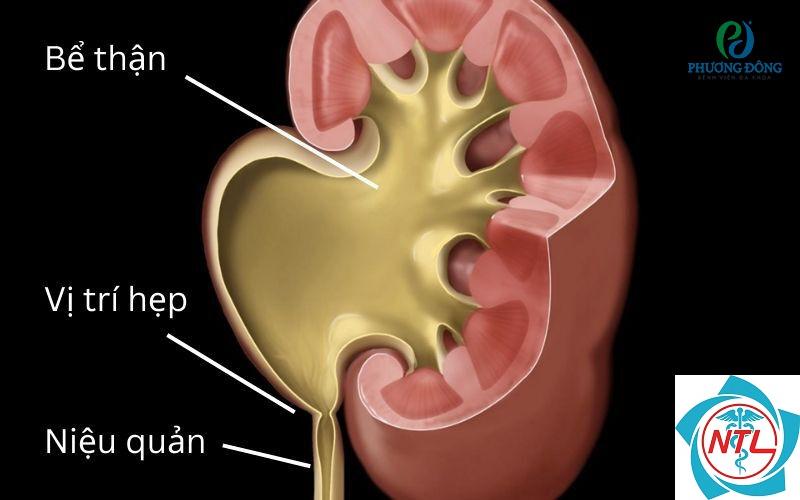 hẹp niệu quản bẩm sinh - Image 2