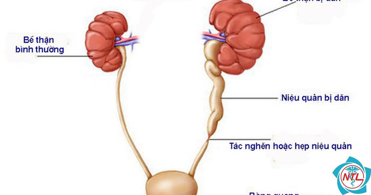 hẹp niệu quản - Image 1