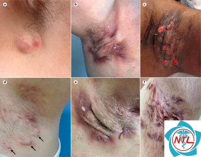 hidradenitis suppurativa - Image 1