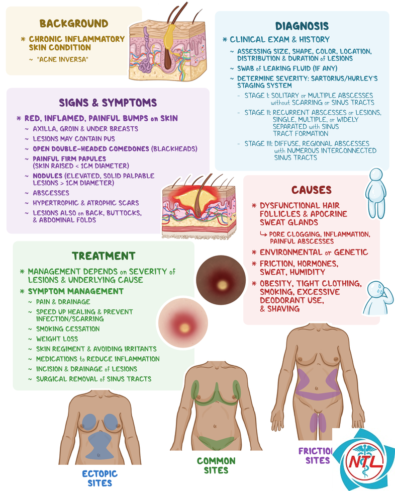 hidradenitis suppurativa - Image 3