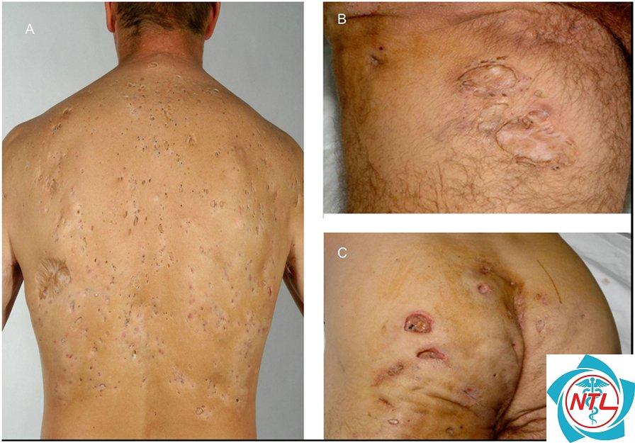 hidradenitis suppurativa - Image 4
