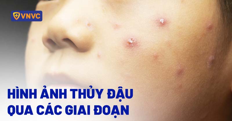 hình ảnh bệnh thủy đậu ở trẻ em