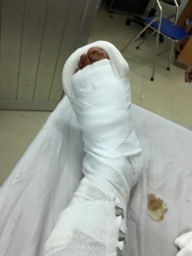 hình ảnh chân bó bột - Image 2